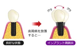 歯周病の治癒を確認してからのインプラント治療