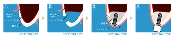 サイナスリフト
