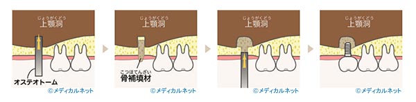ソケットリフト