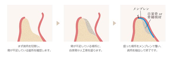 GBR法