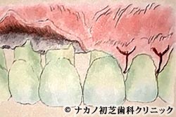 歯肉剥離掻爬術