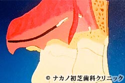 歯肉弁根尖側移動術
