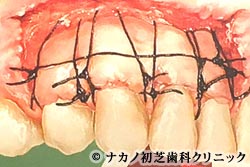 遊離歯肉移植術