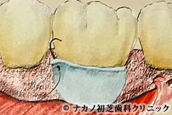 歯周組織再生療法