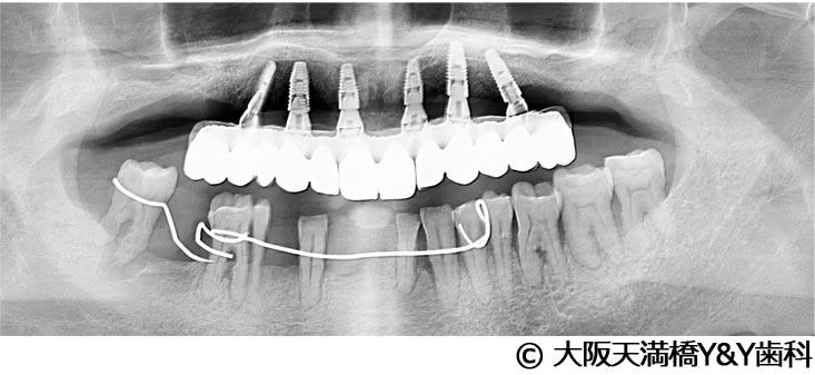 治療後