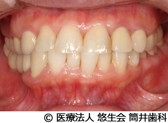 治療後