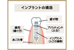 インプラントとは
