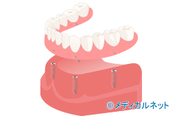 オーバーデンチャー