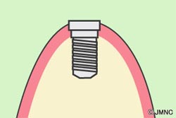 インプラントを埋め込む