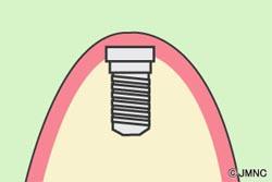 インプラントを埋め込む