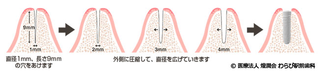 歯を削らずにインプラントを埋め込める治療