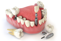 日本口腔インプラント学会 専門医によるインプラント治療