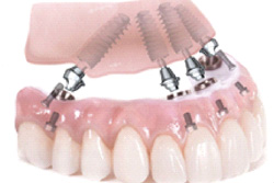 All-on-4�˴�Ť����ܥ���ץ��ȼ���