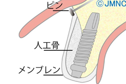 骨の量を増やす治療に対応