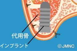 サイナスリフト法