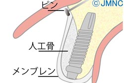 GBR法