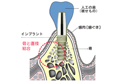 インプラント治療の注意点
