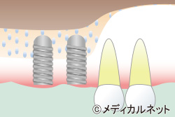 サイナスリフト
