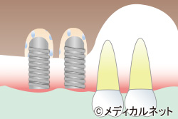 ソケットリフト