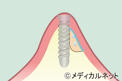 GBR法