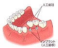 インプラントとは