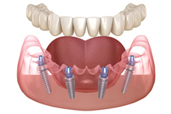 ܤ˥ץȼŤ˾All-on-4