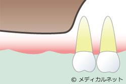 上顎の骨がやせている場合