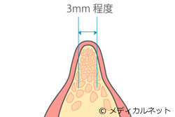 顎の骨の幅がやせている場合