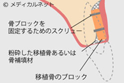 その他の骨造成方法