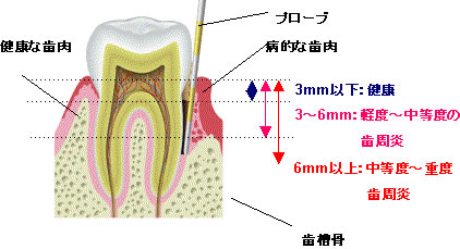 歯周病診査(歯周ポケット測定)