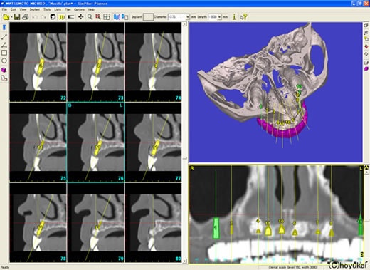3Dシミュレーションソフトによる画像診断