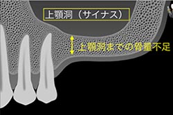 サイナスリフト