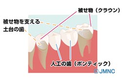 【ブリッジとの比較】