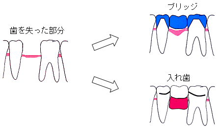インプラントとは?