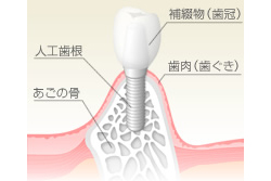 当院のインプラント治療