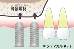 サイナスリフト法