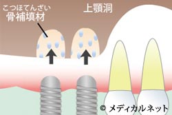 ソケットリフト法