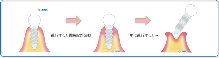 こんな方にお勧め ～インプラント治療後のケアに～