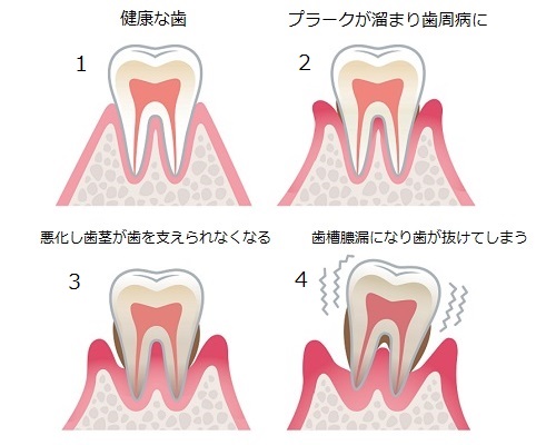 歯槽膿漏(しそうのうろう)