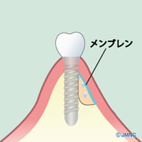 痛みに配慮したインプラント