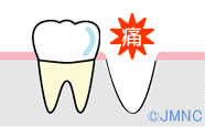 ドライソケット