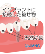 インプラントした歯へのホワイトニング