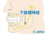 インプラント手術後の【しびれ】