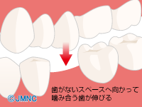 対合の歯が伸びてくる