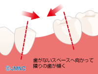 両隣の歯が動いて傾いてくる