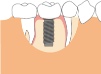 インプラント手術について