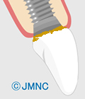 インプラントが臭う原因1.清掃不良