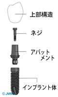 インプラントが臭う原因2.連結しているネジの問題