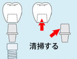 インプラントが臭う原因3.上部構造の問題