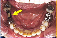 【症例】CASE1　奥歯1本の欠損をインプラントで治療治療前